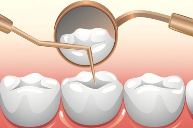 Trám răng bằng vật liệu sứ