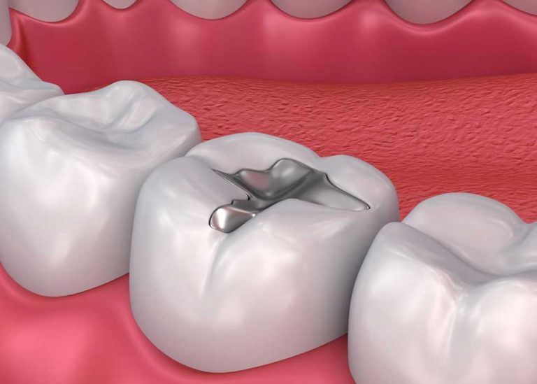 Trám hỗn hợp bạc Amalgam